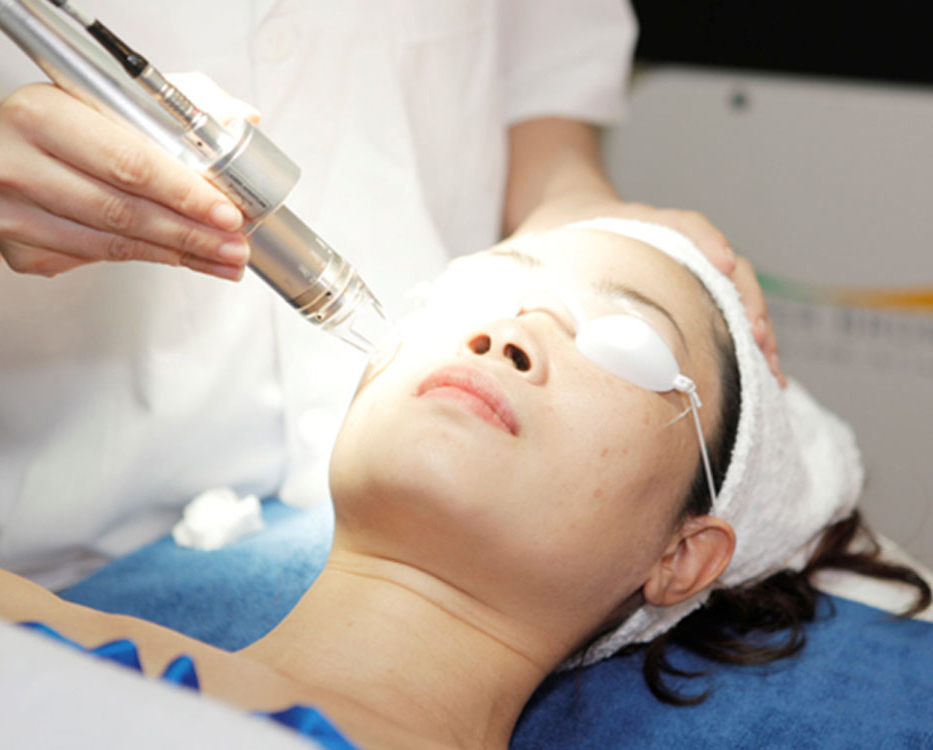 Trị Sẹo Rỗ Sẹo Lõm Bằng Laser Tại Sen Beauty